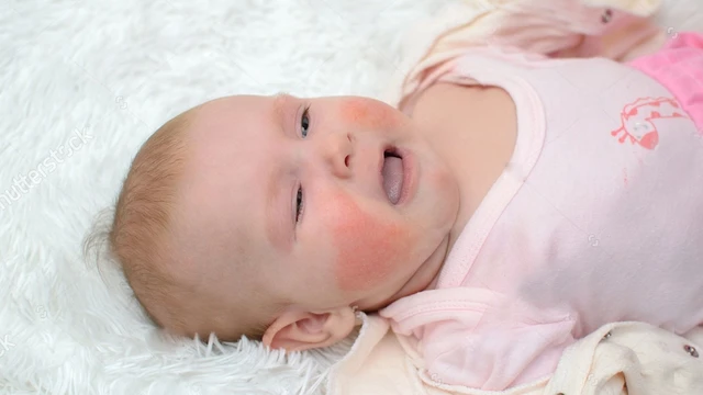 bai-viet/rom-say-co-lay-khong-nhung-dieu-can-biet-ve-rom-say.html