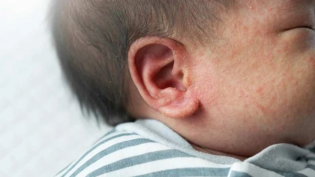 bai-viet/rom-say-ket-tinh-la-gi-dac-diem-nguyen-nhan-va-cach-dieu-tri.html