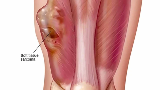 bai-viet/sarcoma-co-van-o-tre-em-khai-niem-phan-loai-va-mo-ta-63456.html