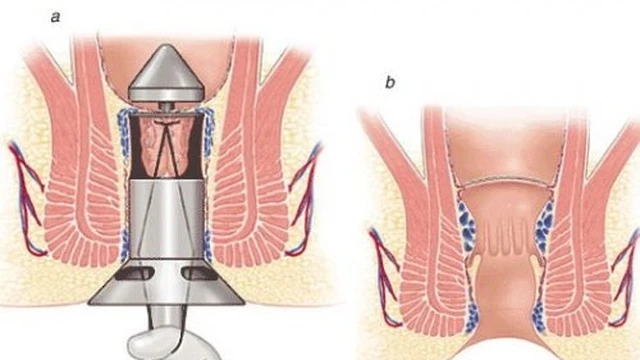 bai-viet/sau-khi-cat-tri-co-tai-phat-khong.html