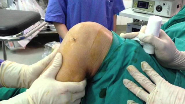 bai-viet/sau-mo-day-chang-cheo-truoc-bao-lau-di-duoc-luu-y-giup-nguoi-benh-phuc-hoi-nhanh-chong.html