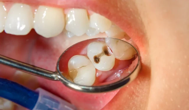 bai-viet/sau-rang-co-di-truyen-khong-cac-bien-phap-phong-ngua-sau-rang-hieu-qua.html