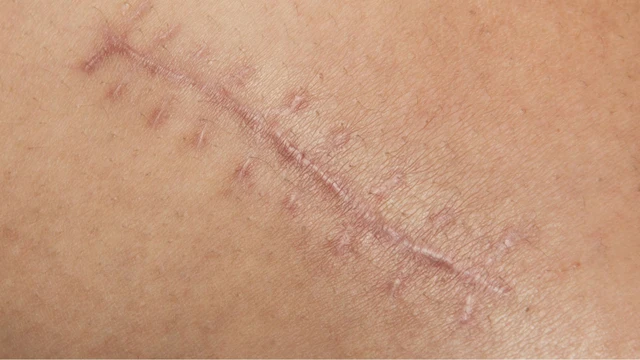 bai-viet/seo-bao-lau-thi-mo-cac-luu-y-khi-cham-soc-seo.html