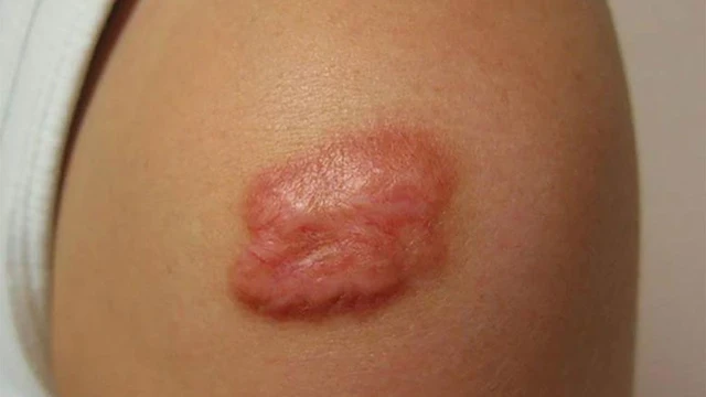 bai-viet/seo-do-bao-lau-thi-het-cach-dieu-tri-seo-do-hieu-qua-60673.html