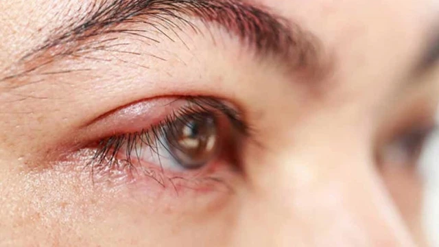 bai-viet/seo-loi-goc-mat-nhung-luu-y-va-cach-dieu-tri-55208.html