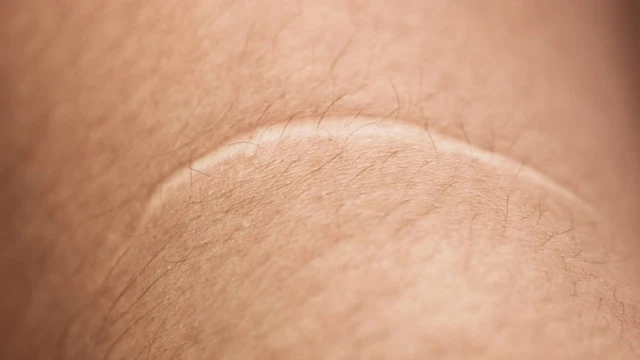 bai-viet/seo-loi-mau-trang-co-chua-khoi-duoc-khong-56362.html