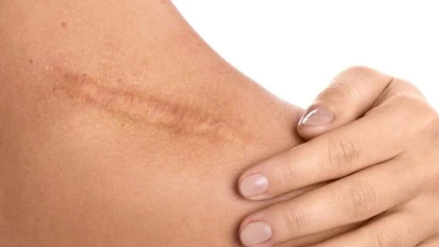 bai-viet/seo-phang-nguyen-nhan-va-cach-dieu-tri-seo-phang.html