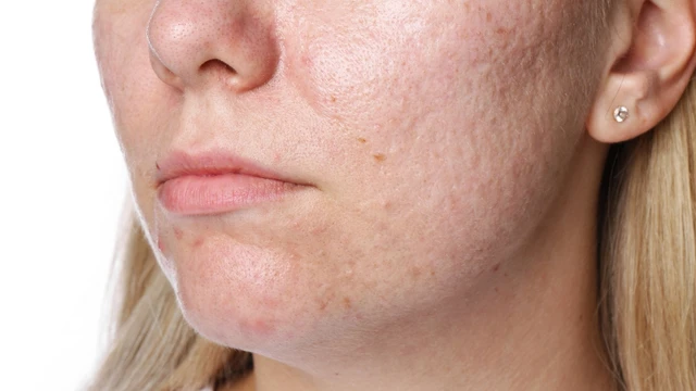 bai-viet/seo-ro-nhe-co-het-khong-cac-phuong-phap-dieu-tri-seo-ro.html