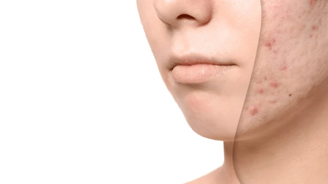 bai-viet/seo-thuy-dau-bao-lau-thi-het-cach-han-che-seo-khi-mac-benh.html