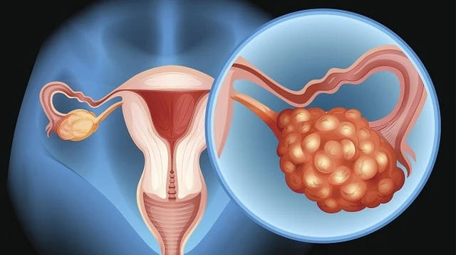 bai-viet/sieu-am-co-phat-hien-ung-thu-buong-trung-khong.html