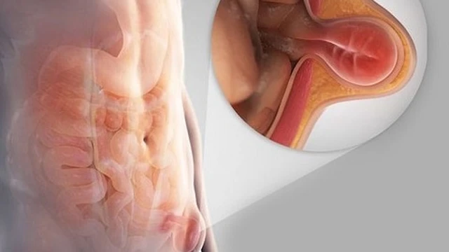 bai-viet/mo-thoat-vi-ben-bao-lau-thi-lanh.html