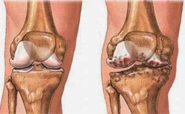 benh/voi-hoa-sun-khop-259.html