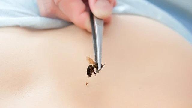 bai-viet/di-ung-con-trung-dot-phai-lam-sao.html