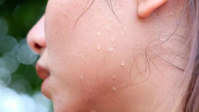 bai-viet/do-mo-hoi-lanh-la-tinh-trang-nhu-the-nao-nguyen-nhan-va-cach-khac-phuc.html