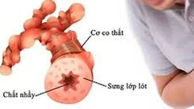 bai-viet/hen-phe-quan-khong-nen-dung-thuoc-gi.html