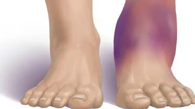 bai-viet/huong-dan-quan-bang-co-chan-dung-cach-khi-bi-lat-co-chan-54588.html