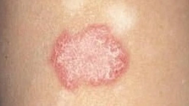 bai-viet/lupus-ban-do-o-chan-trieu-chung-nguyen-nhan-va-phuong-phap-chua-tri-57389.html