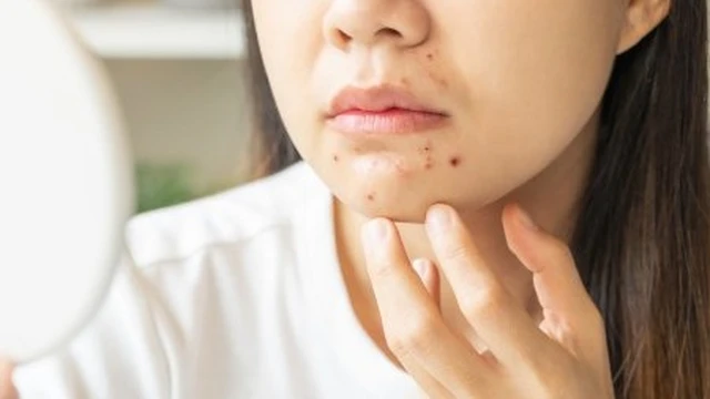 bai-viet/mun-cam-o-cam-nguyen-nhan-dau-hieu-va-cach-dieu-tri.html