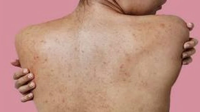 bai-viet/nhung-cach-tri-tham-mun-lung-lau-nam-than-toc-66874.html