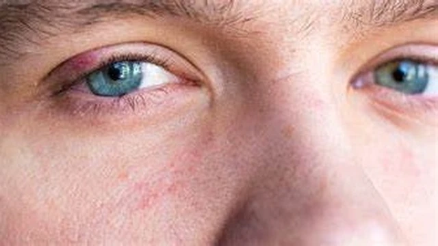 bai-viet/noi-cuc-trong-mi-mat-la-gi-trieu-chung-nguyen-nhan-va-phuong-phap-dieu-tri.html