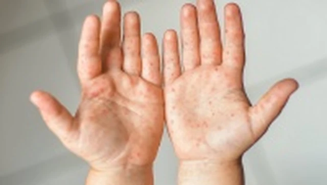 bai-viet/tay-chan-mieng-do-1-may-ngay-thi-khoi-can-luu-y-nhung-gi.html