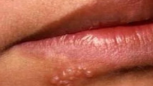 bai-viet/thuc-hu-ve-benh-mun-rop-sinh-duc-co-tu-khoi-58780.html