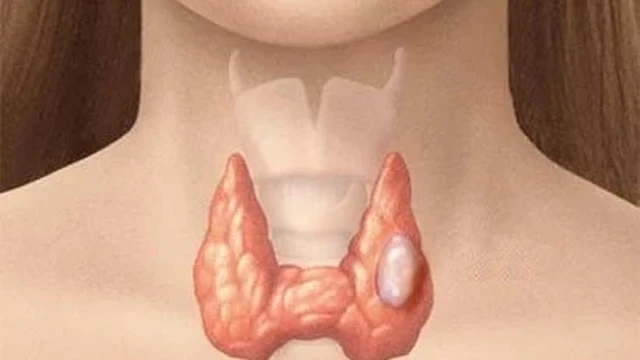 bai-viet/tirads-5-la-gi-tirads-5-co-nguy-hiem-khong.html