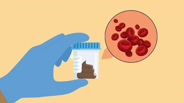 benh/ung-thu-truc-trang-giai-doan-1.html