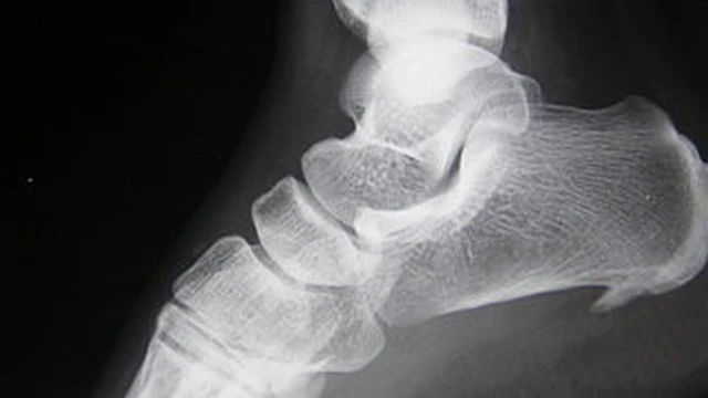 bai-viet/viem-can-gan-chan-bao-lau-thi-khoi-56652.html