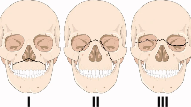 bai-viet/cach-so-cuu-tai-cho-gay-xuong-ham-tren-57578.html