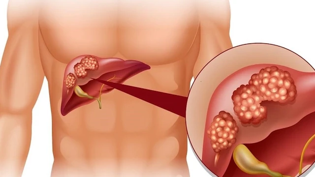 bai-viet/giai-dap-thac-mac-soi-gan-co-nguy-hiem-khong.html