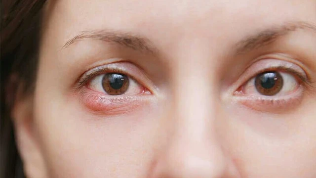 bai-viet/soi-goc-tien-phong-la-gi-nhung-thong-tin-can-biet-ve-soi-goc-tien-phong.html