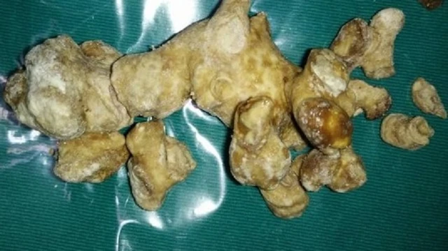 bai-viet/soi-san-ho-dau-hieu-va-cac-phuong-phap-dieu-tri-hieu-qua.html