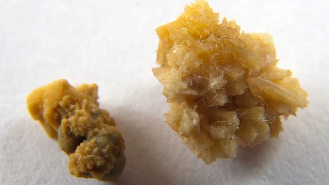 bai-viet/soi-than-hinh-thanh-nhu-the-nao-cac-loai-soi-than-thuong-gap-nhat.html