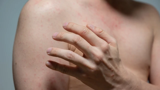 bai-viet/sot-phat-ban-o-nguoi-lon-trieu-chung-nguyen-nhan-va-cach-dieu-tri-hieu-qua.html