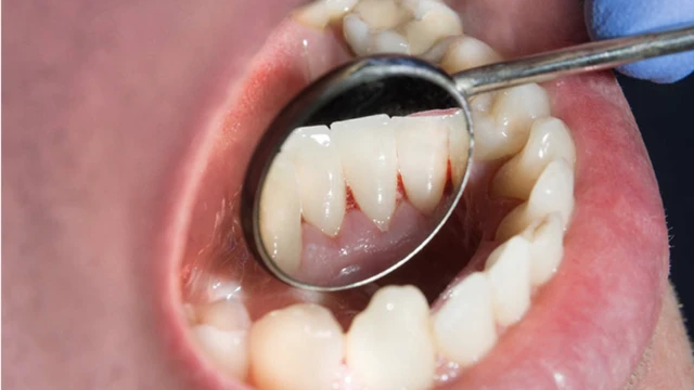 bai-viet/sot-xuat-huyet-chay-mau-chan-rang-co-nguy-hiem-khong.html