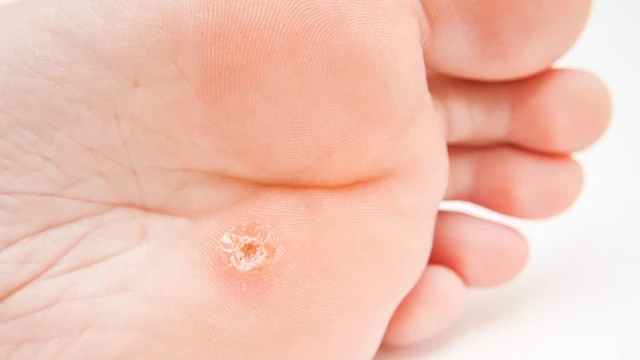 bai-viet/su-dung-acid-salicylic-tri-mun-coc-57761.html