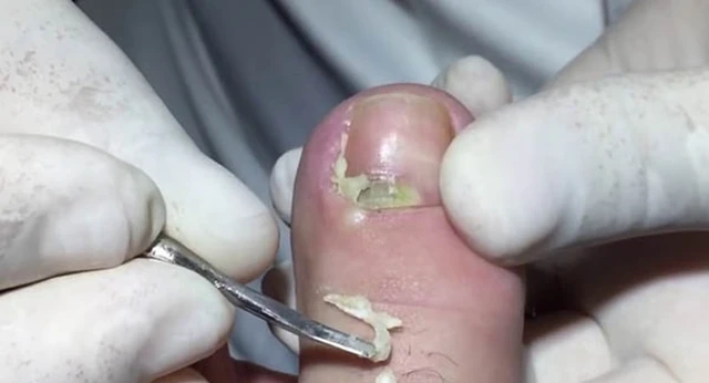 bai-viet/huong-dan-su-dung-cay-lay-khoe-mong-chan-dung-cach-58675.html