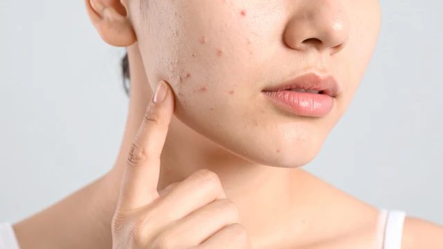 bai-viet/sua-rua-mat-cerave-co-day-mun-khong-cach-ngan-ngua-noi-mun-khi-dung-sua-rua-mat.html