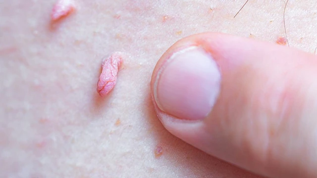 bai-viet/sui-mao-ga-song-duoc-bao-lau-bi-quyet-song-khoe-cho-nguoi-sui-mao-ga.html