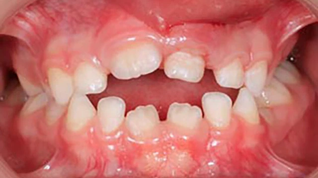 bai-viet/tac-hai-cua-tat-day-luoi-la-gi.html