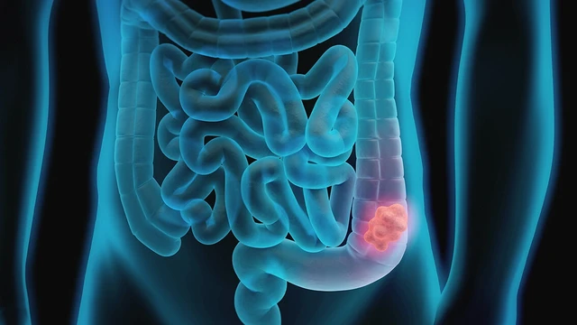 bai-viet/tac-ruot-do-bi-khoi-u-chen-ep-nguyen-nhan-va-cach-dieu-tri.html