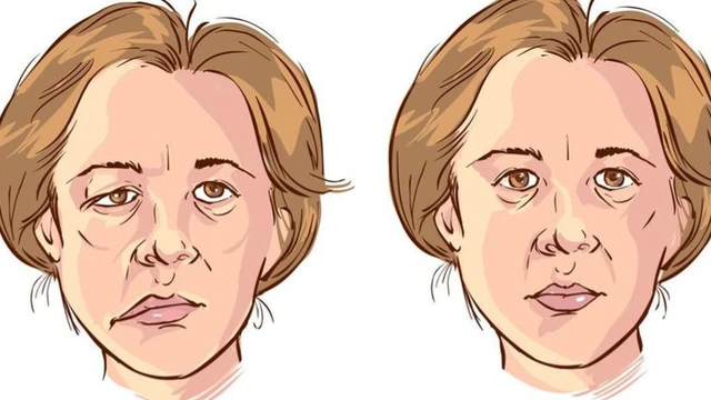 bai-viet/tim-hieu-tai-bien-meo-mieng-do-liet-day-than-kinh-so-7.html