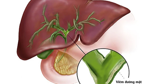 bai-viet/tam-chung-charcot-bieu-hien-lam-sang-va-cach-dieu-tri-phong-ngua.html