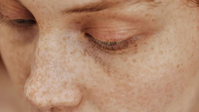 bai-viet/tan-nhang-co-tri-duoc-khong-cac-phuong-phap-dieu-tri-tan-nhang-theo-y-khoa-hien-dai.html