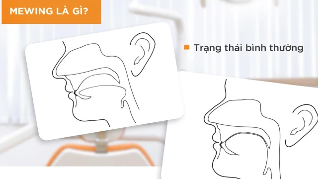 bai-viet/tap-luyen-ky-thuat-mewing-co-giup-mui-nho-lai-khong-hay-chi-la-ngo-nhan-65154.html