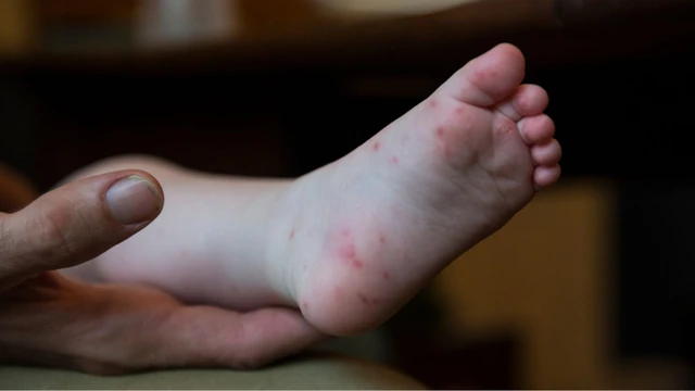 bai-viet/tay-chan-mieng-do-4-la-gi-co-nguy-hiem-khong.html