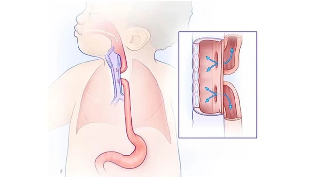 bai-viet/teo-thuc-quan-bam-sinh-nguyen-nhan-trieu-chung-va-cach-dieu-tri.html