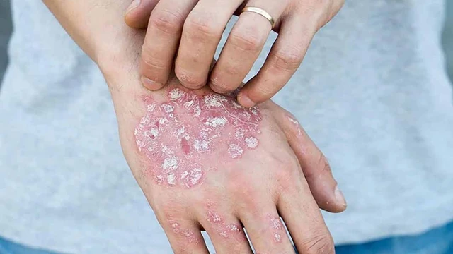 bai-viet/benh-hac-lao-co-nguy-hiem-khong-co-rat-khong-55381.html