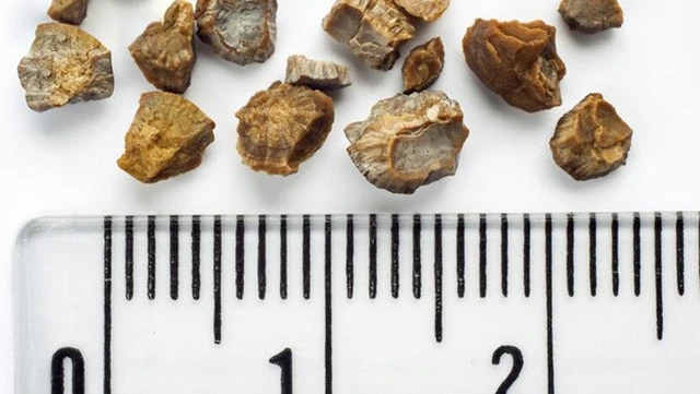 bai-viet/thac-mac-soi-mat-co-kich-thuoc-bao-nhieu-phai-mo-53889.html